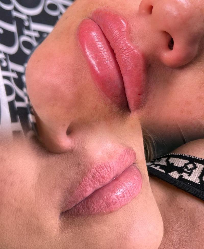 AUMENTO DE LABIOS